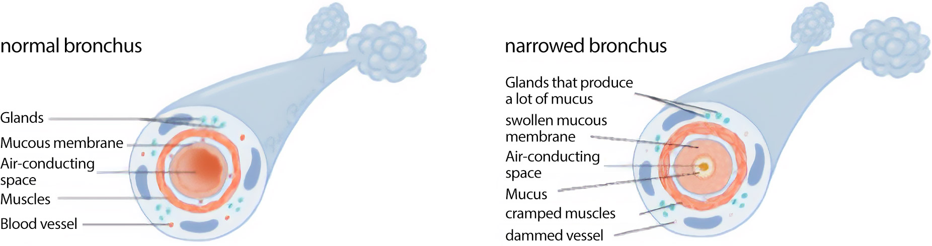 Bronchial asthma